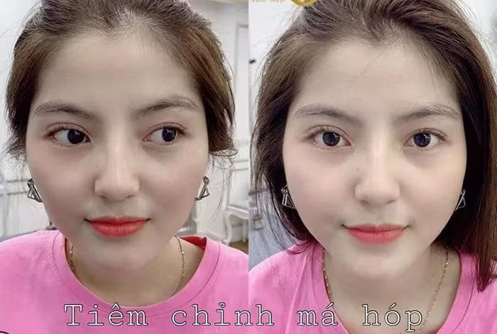 Vợ Quang Hải xuất hiện sau loạt drama mặt lạ hoắc nghi vừa dao kéo